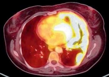 mesothelioma-treatment