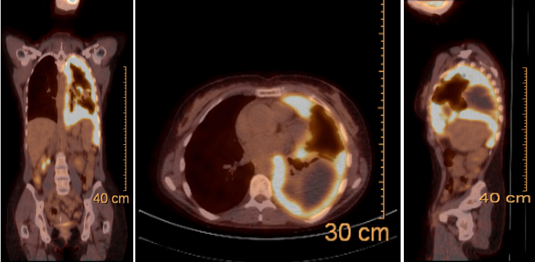 hypertrophic osteoarthropathy mesothelioma