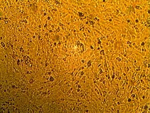 This photo shows mesothelioma cells from a mouse