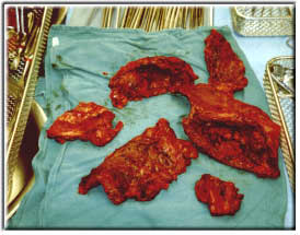 Removed tumors