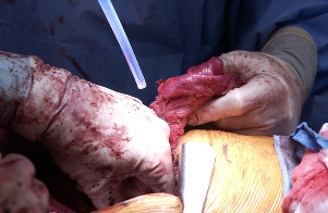 Let my lung breathe! Dr. Peng holding the tumor while Dr. Cameron peels the tumor from the lung.