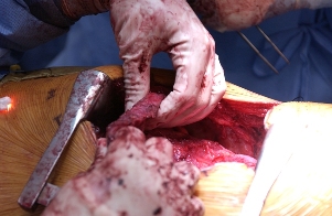Out, out! Dr. Cameron holds the thick, rubbery tumor after meticulously scraping it off the thin diaphragm muscle.