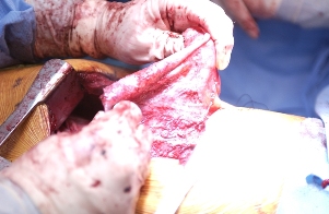The devil by its horns. After stripping the tumor off the chest wall and lung apex, Dr. Cameron holds a flap of tumor. Fours hours to go.