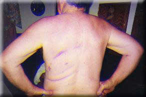Charley Baker, post surgery