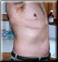 Post Extra-Pleural Pneumonectomy
