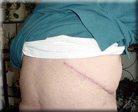 Ted's Surgical Scars