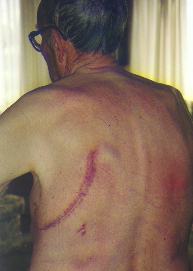 Russell Denton, post-surgery