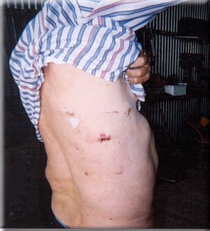 Aloys' biopsy scars