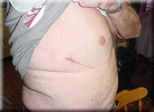 Joe Galarneau, post surgery