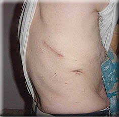 David Galea, post surgery