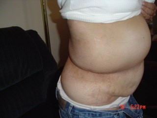 A tumor has recently developed above Sandie's waist line