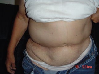 A tumor has recently developed above Sandie's waist line