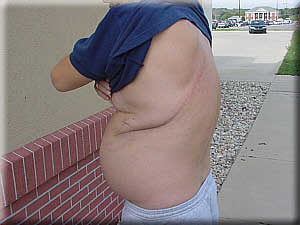 Marty's surgical scars