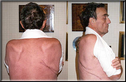 Post Extra-Pleural Pneumonectomy - 11/17/99