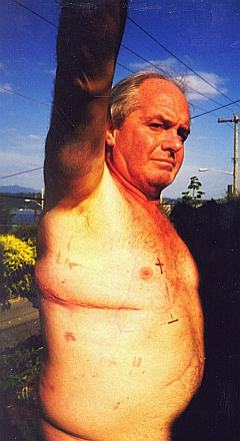 Sam Paffile, post surgery