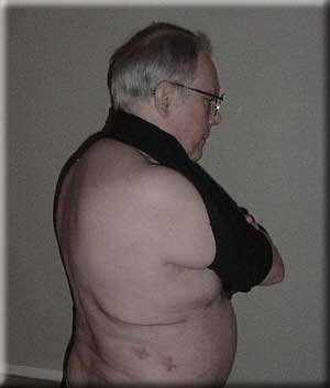 Thoracotomy scars from Robert's December 6, 2001 surgery