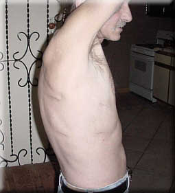 Surgical Scars